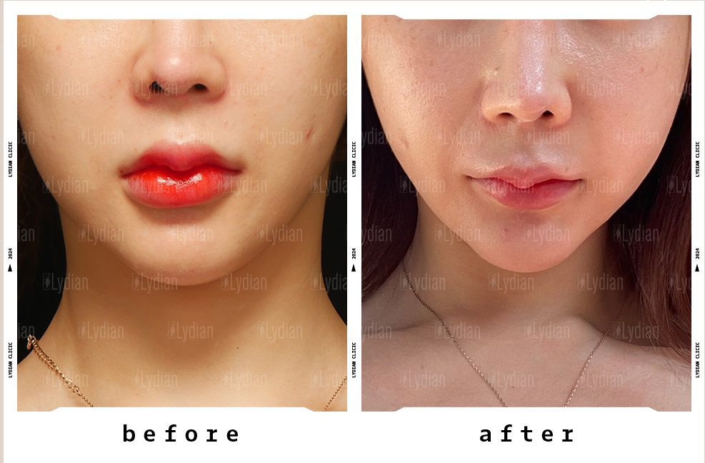 Liposuction