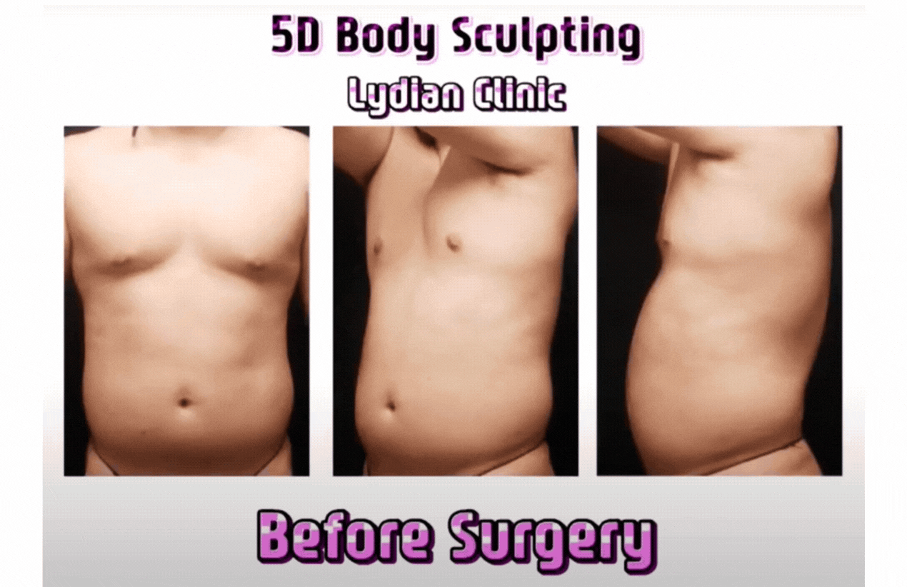 liposculpture before and after pictures