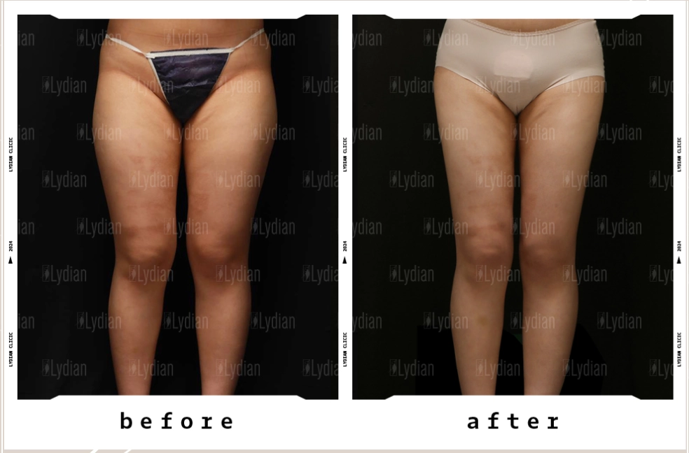 before and after image of thigh liposuction