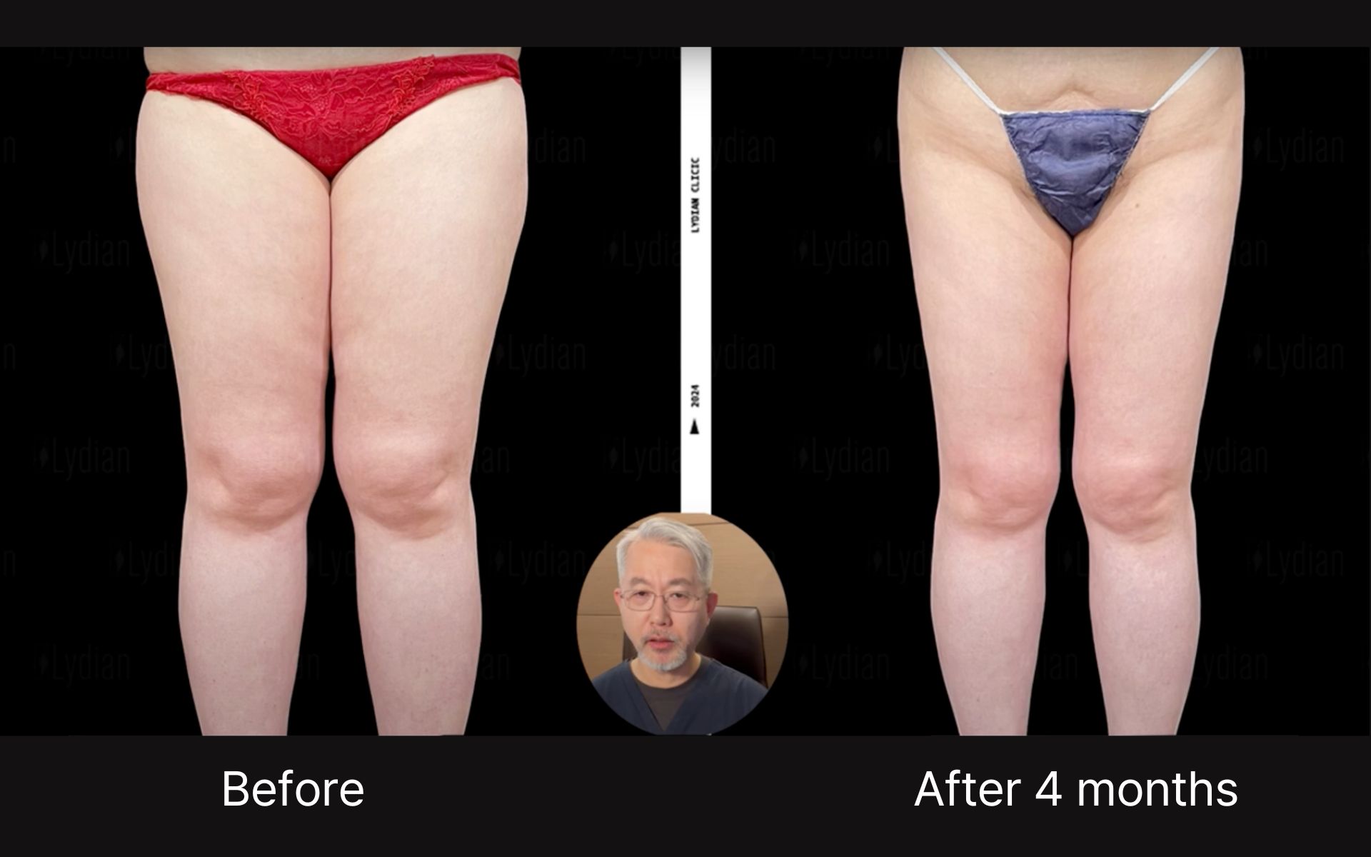 thigh liposuction scars-1