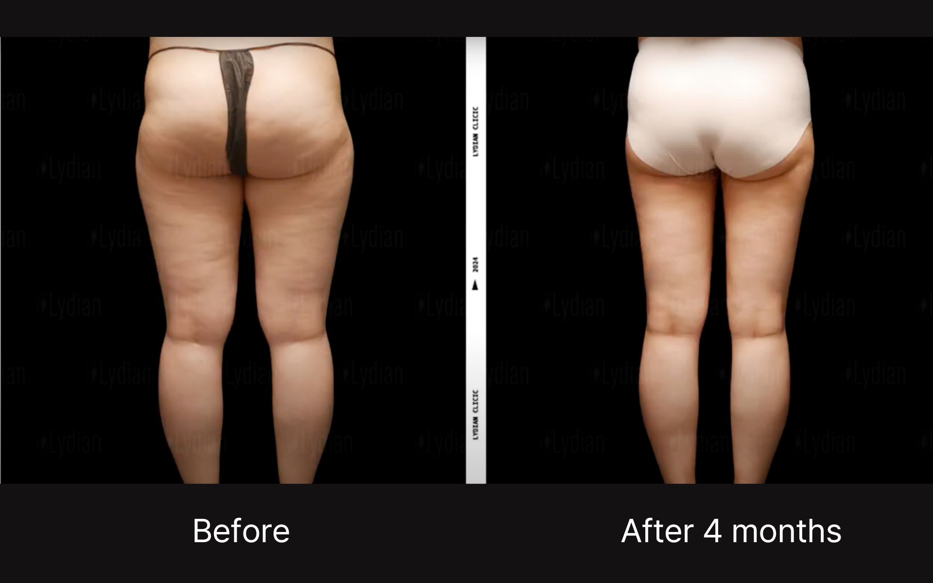 thigh liposuction scars-2