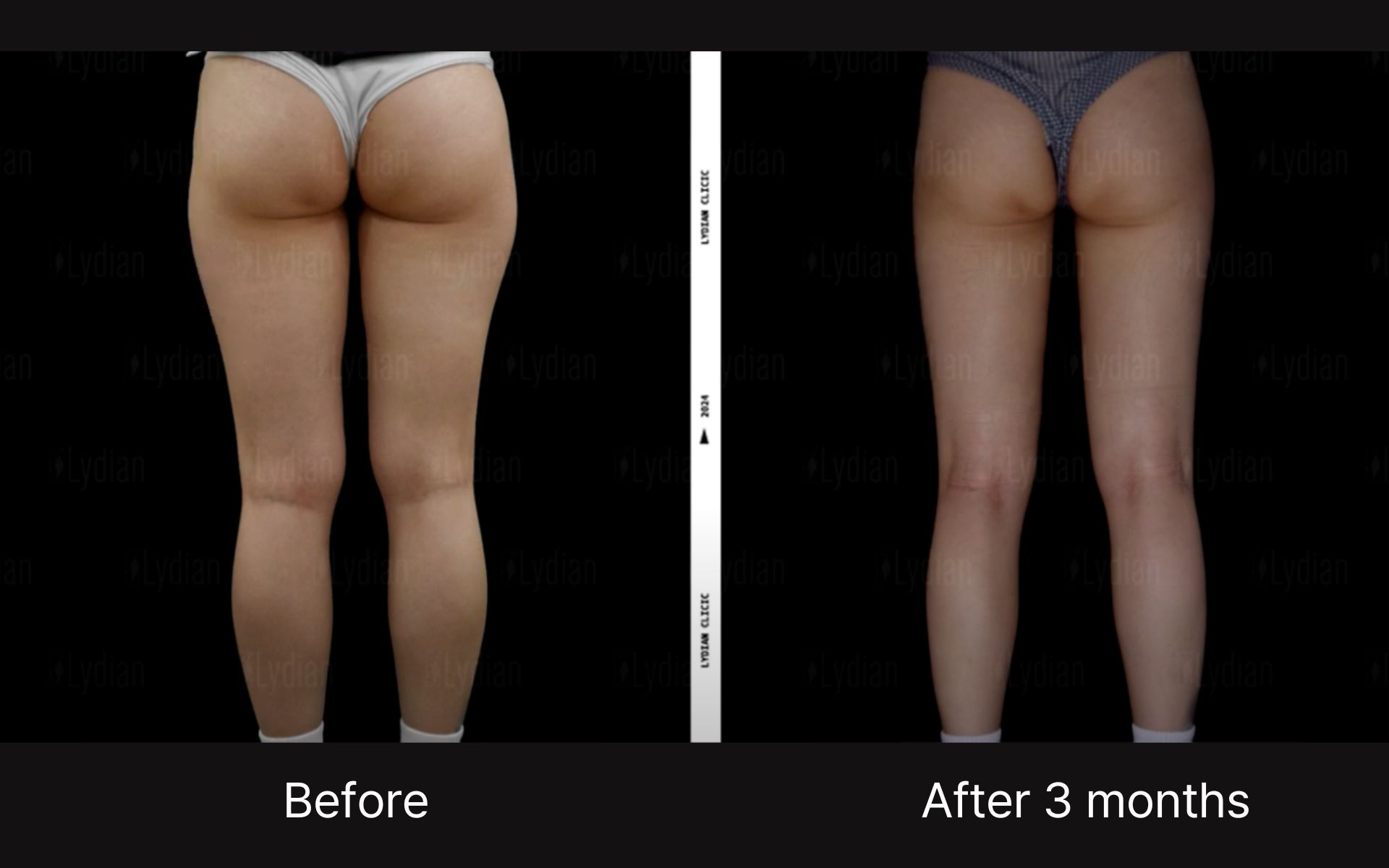 thigh liposuction scars-4