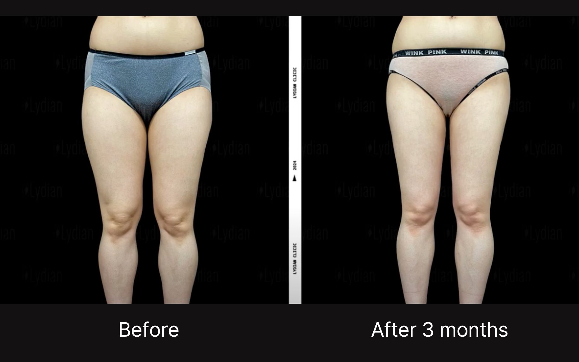 thigh liposuction scars-5