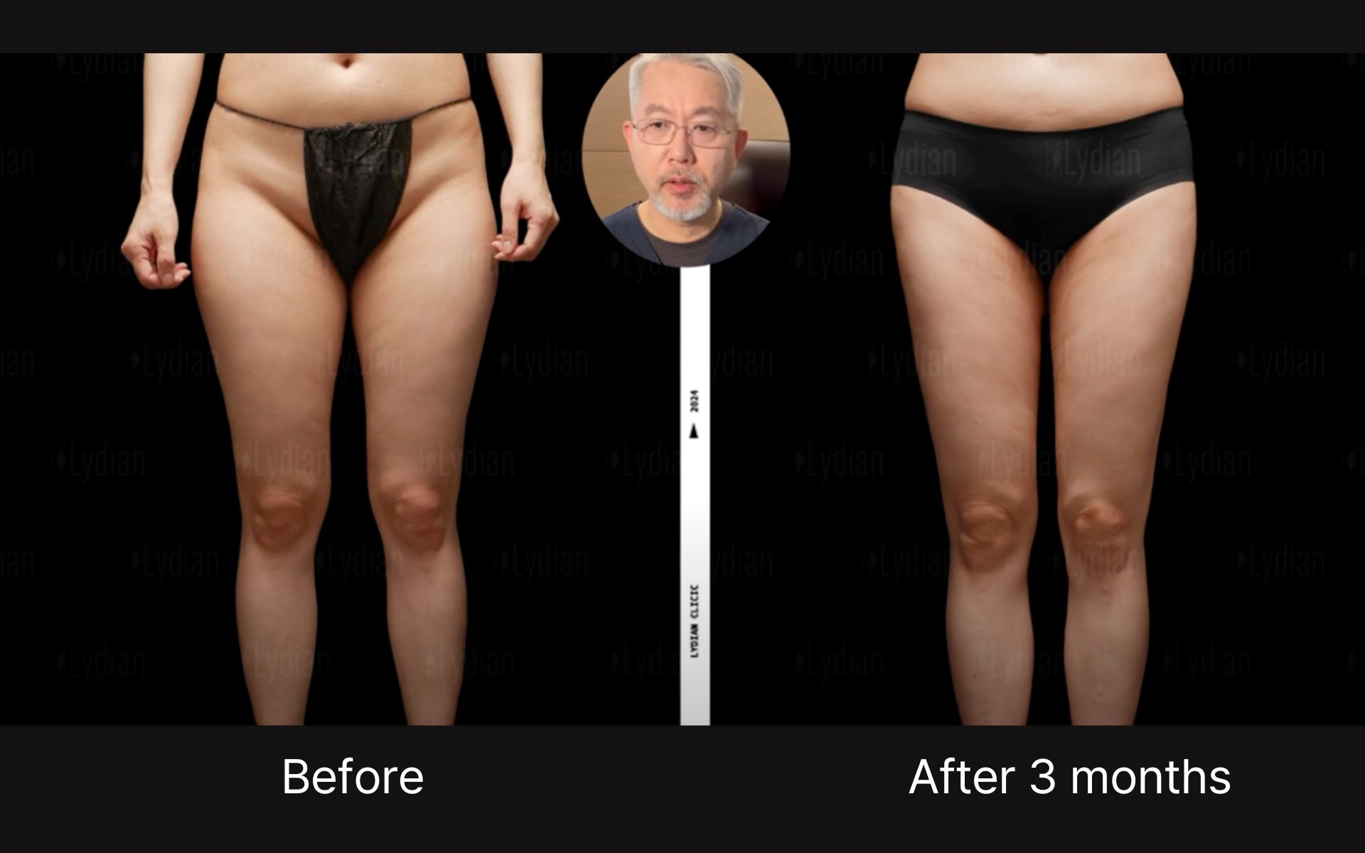 thigh liposuction scars-6