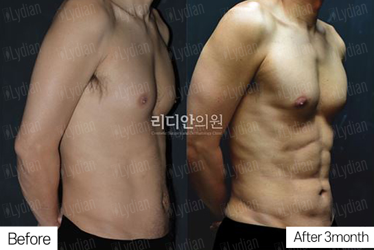 six-pack-abs-surgery-korea