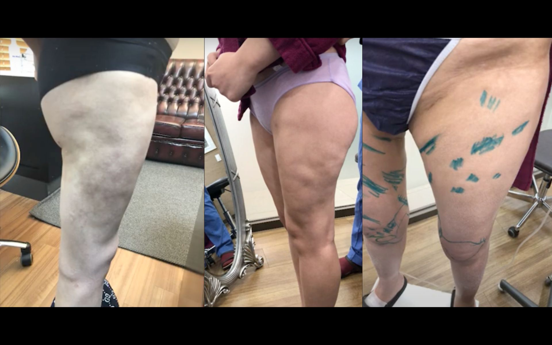 liposuction thigh scars photos