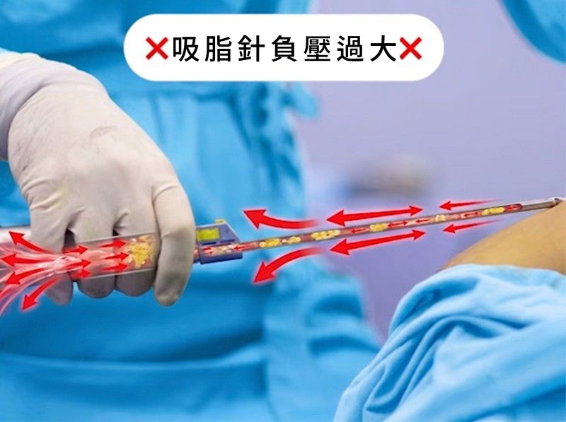 吸脂針負壓